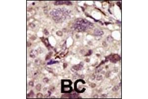 Formalin-fixed and paraffin-embedded human cancer tissue reacted with the primary antibody, which was peroxidase-conjugated to the secondary antibody, followed by DAB staining.