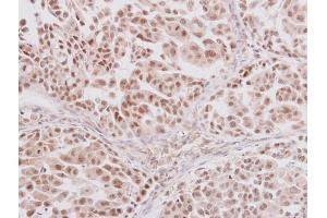 IHC-P Image GLI3 antibody detects GLI3 protein at nucleus on human lung adenocarcinoma by immunohistochemical analysis.
