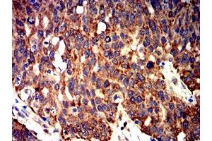 Immunohistochemical analysis of paraffin-embedded ovarian cancer tissues using BCL2L2 mouse mAb with DAB staining.