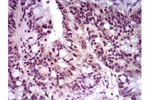 Immunohistochemical analysis of paraffin-embedded rectum cancer tissues using T mouse mAb with DAB staining. (T Antigen (AA 257-309) anticorps)