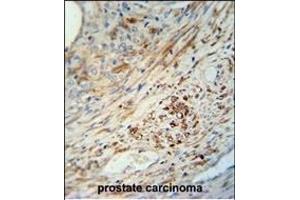 KIF9 antibody (C-term) (ABIN652134 and ABIN2840560) immunohistochemistry analysis in formalin fixed and paraffin embedded human prostate carcinoma followed by peroxidase conjugation of the secondary antibody and DAB staining.