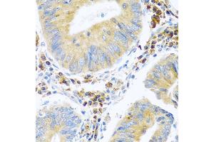 Immunohistochemistry of paraffin-embedded human colon carcinoma using MANF antibody. (MANF anticorps)