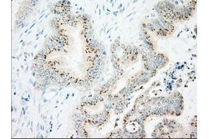 Immunohistochemical staining of paraffin-embedded Adenocarcinoma of Human colon tissue using anti-IFT57 mouse monoclonal antibody. (IFT57 anticorps)