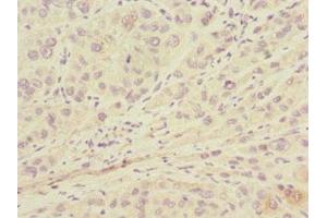 Immunohistochemistry of paraffin-embedded human liver cancer using ABIN7157914 at dilution of 1:100 (LSS anticorps  (AA 1-300))