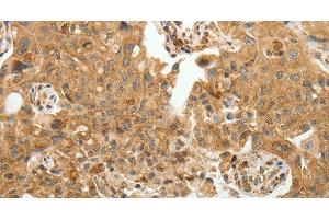 Immunohistochemistry of paraffin-embedded Human lung cancer tissue using TFPI2 Polyclonal Antibody at dilution 1:30 (TFPI2 anticorps)