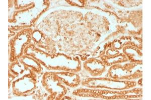 Formalin-fixed, paraffin-embedded human Renal Cell Carcinoma stained with Calnexin Mouse Monoclonal Antibody (CANX/1541).