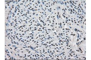 Immunohistochemical staining of paraffin-embedded Carcinoma of thyroid tissue using anti-FKBP5mouse monoclonal antibody. (FKBP5 anticorps)