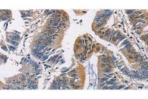 Immunohistochemistry of paraffin-embedded Human colon cancer using PGK1 Polyclonal Antibody at dilution of 1:50