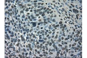 Immunohistochemical staining of paraffin-embedded Adenocarcinoma of breast tissue using anti-SATB1 mouse monoclonal antibody.