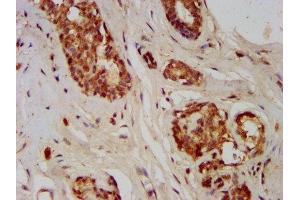 IHC image of ABIN7153745 diluted at 1:400 and staining in paraffin-embedded human breast cancer performed on a Leica BondTM system. (GMDS anticorps  (AA 243-346))
