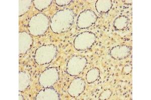 Immunohistochemistry of paraffin-embedded human gastric cancer using ABIN7143774 at dilution of 1:100 (A4GNT anticorps  (AA 26-340))