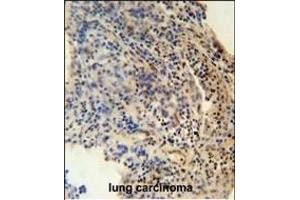 ZN antibody (N-term) (ABIN654489 and ABIN2844223) immunohistochemistry analysis in formalin fixed and paraffin embedded human lung carcinoma followed by peroxidase conjugation of the secondary antibody and DAB staining. (ZNF197 anticorps  (N-Term))