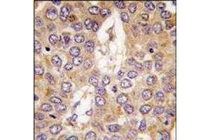 Formalin-fixed and paraffin-embedded human hepatocarcinoma tissue reacted with CK1g2 antibody (C-term), which was peroxidase-conjugated to the secondary antibody, followed by DAB staining. (Casein Kinase 1 gamma 2 anticorps  (C-Term))