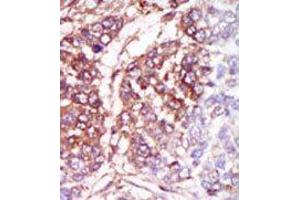 Formalin-fixed and paraffin-embedded human cancer tissue reacted with the primary antibody, which was peroxidase-conjugated to the secondary antibody, followed by DAB staining. (CSNK1G3 anticorps  (C-Term))