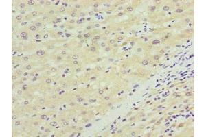 Immunohistochemistry of paraffin-embedded human liver cancer using ABIN7170048 at dilution of 1:100 (NKAIN4 anticorps  (AA 83-150))