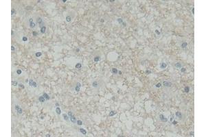 Detection of SNAP25 in Human Glioma Tissue using Polyclonal Antibody to Synaptosomal Associated Protein 25 kDa (SNAP25) (SNAP25 anticorps  (AA 1-206))