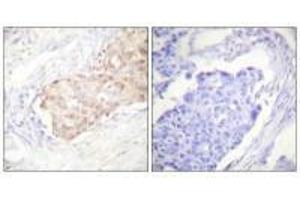 Immunohistochemistry analysis of paraffin-embedded human breast carcinoma tissue using EDD antibody. (UBR5 anticorps)