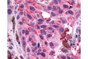 Anti-NPY1R antibody IHC of human Skin, Melanoma.