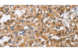 Immunohistochemistry of paraffin-embedded Human thyroid cancer using BCL10 Polyclonal Antibody at dilution of 1:40