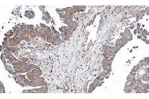 IHC-P Image Immunohistochemical analysis of paraffin-embedded human ovarian cancer, using NT5C2, antibody at 1:100 dilution. (NT5C2 anticorps)