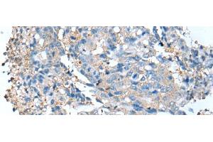 Immunohistochemistry of paraffin-embedded Human colorectal cancer tissue using DCX Polyclonal Antibody at dilution of 1:35(x200) (Doublecortin anticorps)
