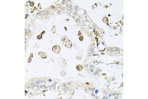Immunohistochemistry of paraffin-embedded human gastric cancer using AIF1 antibody (ABIN5970719) at dilution of 1/100 (40x lens). (Iba1 anticorps)
