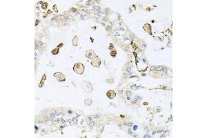 Immunohistochemistry of paraffin-embedded human gastric cancer using AIF1 antibody (ABIN5970719) at dilution of 1/100 (40x lens). (Iba1 anticorps)