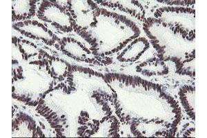 Immunohistochemical staining of paraffin-embedded Adenocarcinoma of Human colon tissue using anti-MLF1 mouse monoclonal antibody. (MLF1 anticorps)