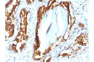 IHC testing of human prostate carcinoma with recombinant PSAP antibody (clone rACPP/1338). (Prosaposin anticorps)