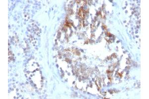 Formalin-fixed, paraffin-embedded human Testicular Carcinoma stained with SHBG Monoclonal Antibody (SPM605) (SHBG anticorps)