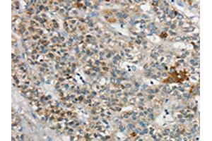 The image on the left is immunohistochemistry of paraffin-embedded Human liver cancer tissue using ABIN7192710(SYCP3 Antibody) at dilution 1/20, on the right is treated with synthetic peptide. (SYCP3 anticorps)
