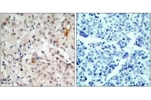 Immunohistochemistry analysis of paraffin-embedded human breast carcinoma tissue, using HER2 (Ab-1221/1222) Antibody. (ErbB2/Her2 anticorps  (AA 1191-1240))