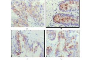 Immunohistochemical analysis of paraffin-embedded human lung cancer (A), recturn(B), prostate (C), colon cancer (D) showing cytoplasmic localization using IGFBP2 mouse mAb with DAB staining. (IGFBP2 anticorps)