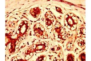 IHC image of ABIN7148050 diluted at 1:300 and staining in paraffin-embedded human breast cancer performed on a Leica BondTM system.