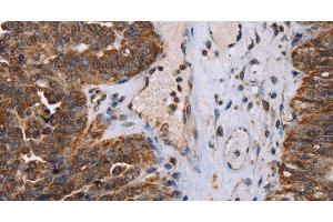 Immunohistochemistry of paraffin-embedded Human ovarian cancer tissue using DDX11 Polyclonal Antibody at dilution 1:30 (DDX11 anticorps)