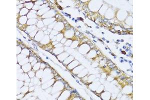 Immunohistochemistry of paraffin-embedded Human colon carcinoma using ALOX12 Polyclonal Antibody at dilution of 1:100 (40x lens).
