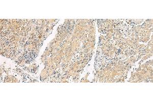 Immunohistochemistry of paraffin-embedded Human cervical cancer tissue using HEBP1 Polyclonal Antibody at dilution of 1:60(x200) (HEBP1 anticorps)