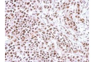 IHC-P Image Immunohistochemical analysis of paraffin-embedded HeLa xenograft, using Chk1 (phospho Ser345) , antibody at 1:500 dilution.