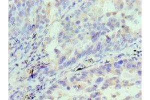 Immunohistochemistry of paraffin-embedded human lung cancer using ABIN7156833 at dilution of 1:100