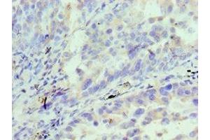 Immunohistochemistry of paraffin-embedded human lung cancer using ABIN7156833 at dilution of 1:100 (IL18RAP anticorps  (AA 390-599))