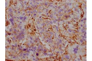 IHC image of ABIN7180354 diluted at 1:100 and staining in paraffin-embedded human liver cancer performed on a Leica BondTM system. (ACTB/POTEKP/ACTG1 anticorps)