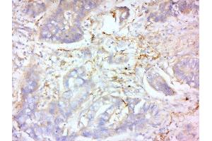 Formalin-fixed and paraffin embedded human lung carcinoma labeled with Anti-MMP-2 Polyclonal Antibody, Unconjugated  at 1:200 followed by conjugation to the secondary antibody and DAB staining. (MMP2 anticorps  (AA 401-500))