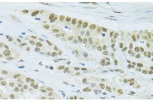 Immunohistochemistry of paraffin-embedded Human colon carcinoma using FIP1L1 Polyclonal Antibody at dilution of 1:100 (40x lens).