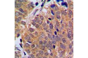 Immunohistochemical analysis of p18 INK4c staining in human breast cancer formalin fixed paraffin embedded tissue section.