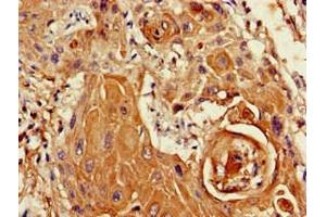 Immunohistochemistry of paraffin-embedded human cervical cancer using ABIN7169412 at dilution of 1:100 (SETD5 anticorps  (AA 519-700))
