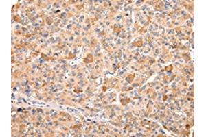 The image on the left is immunohistochemistry of paraffin-embedded Human liver cancer tissue using ABIN7192170(RERE Antibody) at dilution 1/20, on the right is treated with synthetic peptide. (RERE anticorps)