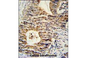 KLHL24 Antibody immunohistochemistry analysis in formalin fixed and paraffin embedded human colon carcinoma followed by peroxidase conjugation of the secondary antibody and DAB staining. (Kelch-Like 24 anticorps  (AA 182-211))