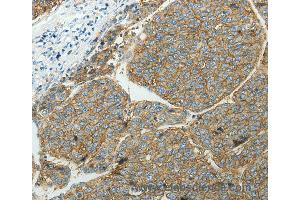 Immunohistochemistry of Human ovarian cancer using SLC16A1 Polyclonal Antibody at dilution of 1:50 (SLC16A1 anticorps)