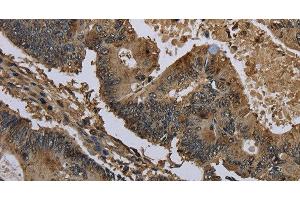 Immunohistochemistry of paraffin-embedded Human colon cancer using GSTO1 Polyclonal Antibody at dilution of 1:60 (GSTO1 anticorps)