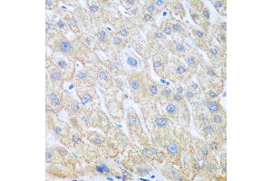 Immunohistochemistry of paraffin-embedded human liver cancer using PTGS1 antibody. (PTGS1 anticorps)